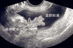 哪些情况引起的盆腔积液需要治疗？