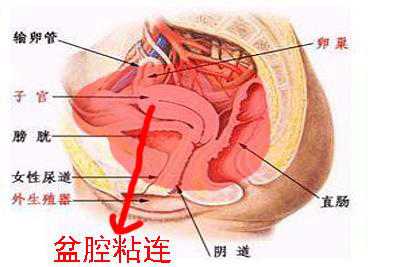 妇炎丸能治盆腔粘连吗