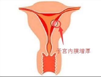 妇炎丸能治子宫内膜增厚吗