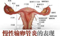 输卵管发炎难治吗？都有哪些治疗方法