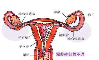 女性怎么判断输卵管不通