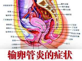 输卵管发炎的症状表现