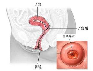 查出宫颈病变要怎么办