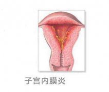 子宫内膜炎可以吃什么药？