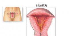 子宫内膜炎怎么治疗彻底？
