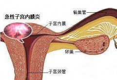 子宫内膜炎出血严重怎么治？