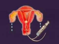 女性输卵管疏通怎么做？