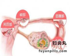 输卵管堵塞的症状介绍