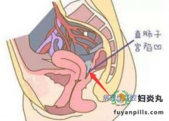 病理性盆腔积液会引发哪些并发症