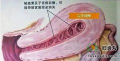 别让宫腔粘连“偷走”了你的月经