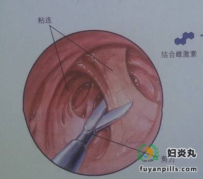 宫腔粘连致不孕 宫腔粘连怎么办