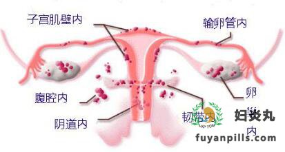 子宫内膜异位症的病因