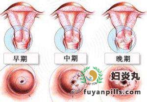 宫颈糜烂都有什么症状