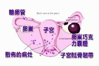 子宫内膜异位症的原因