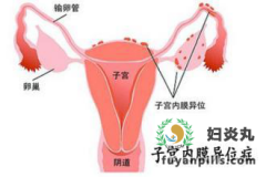 子宫内膜异位为什么会引起头晕头痛?