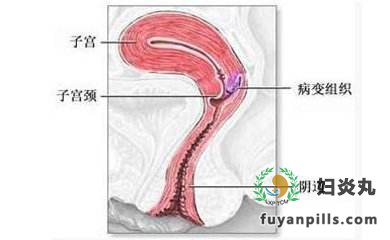 阴道炎的病因有哪些