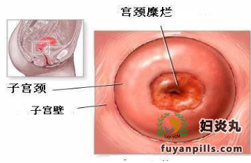 宫颈糜烂用中医治疗靠谱吗?