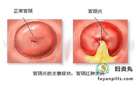 宫颈肥大要不要治疗