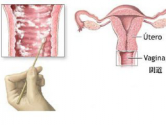怎么治疗阴道炎？避免阴道炎复发？