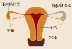 得了输卵管炎怎么治疗才能怀孕？