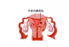 哪些症状提示患有子宫内膜异位症？