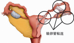 输卵管粘连是不是只会导致不孕呢?