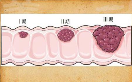 肠癌