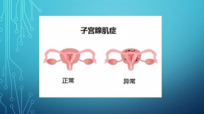 子宫腺肌症