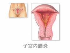 引发子宫内膜炎的病因有哪些?