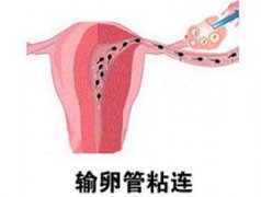 输卵管粘连会影响月经吗?