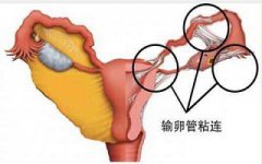 引发输卵管粘连的原因有哪些?