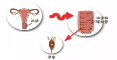 滴虫性阴道炎会影响怀孕吗