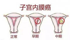 研究显示怀孕有助降低女性患子宫内膜癌的风险