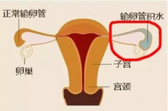 输卵管伞部积水严重吗？