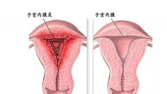 慢性子宫内膜炎的鉴别诊断