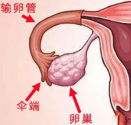 输卵管远端积水会导致卵巢病变吗