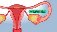 中医治疗子宫内膜增生的方法有哪些?