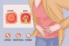 宫颈炎分为哪些类型